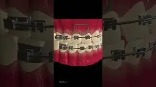 How Does Dental Braces Work