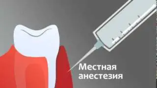 Лечение десен аппаратом Вектор (Vector)