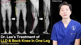 [ENG] Leg Analysis: Why Is My Leg Bent Backward?