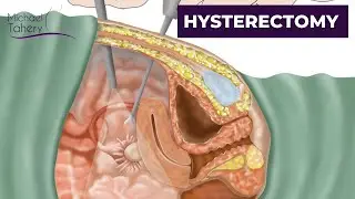 Do You Really Need a Hysterectomy? | Los Angeles | Dr. Michael Tahery