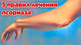 МЫ ВЫЛЕЧИЛИ ПСОРИАЗ /МОЙ СПОСОБ