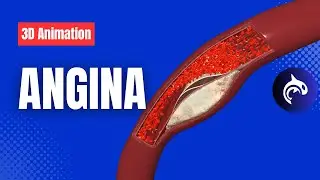 Стенокардия (3D-анимация) – поясните боль в груди из-за снижения притока крови к сердцу