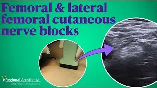 Femoral and lateral femoral cutaneous nerve blocks