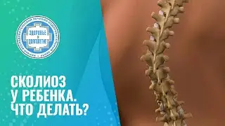 🧒 Сколиоз у ребенка. Что делать?