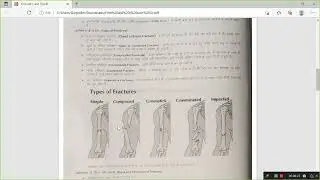 Topic-  Fractures| A.N.M 1ST YEAR | Metro College of Nursing