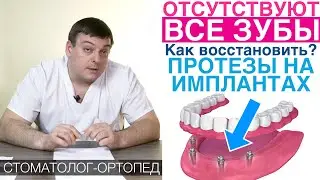 Восстановление зубов протезами на имплантах - All on 4, All on 6. Зубные протезы на имплантах.