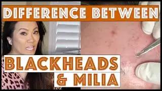 The difference between blackheads and milia with INTRO