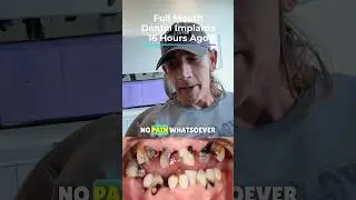 🤕 Do Full Mouth Dental Implants / All-on-4 HURT!!!!#dentalimplant