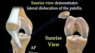 Patellar Dislocations - Everything You Need To Know - Dr. Nabil Ebraheim