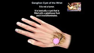 Ganglion Cyst Of The Wrist - Everything You Need To Know - Dr. Nabil Ebraheim