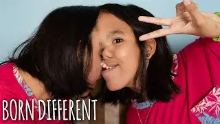 The Incredible Conjoined Twins Attached At The Head | BORN DIFFERENT