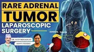 Happy Patient: Rare Adrenal Tumor Laparoscopic Surgery At Apollo Hospital Delhi