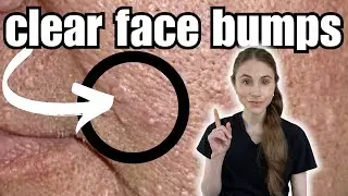 How To Clear And Prevent Face Bumps | Sebaceous Hyperplasia