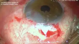 CataractCoach™ 1976: combo phaco and trabeculectomy for glaucoma