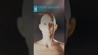 Deep Brain Stimulation