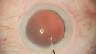 Cataract Surgery With Ophthalmic Microscope | Leica Proveo 8