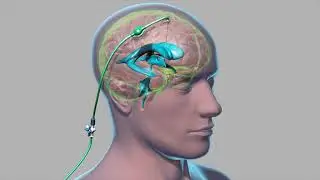 External Ventricular Drain (EVD)