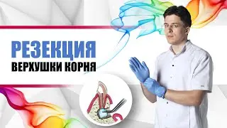 резекция верхушки корня зуба