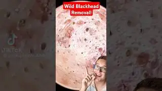 SHOCKING BLACKHEAD REMOVAL - What Is Happening #shorts