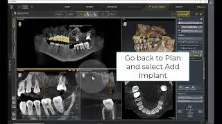 Sicat Implant – Implant Planning Part 1