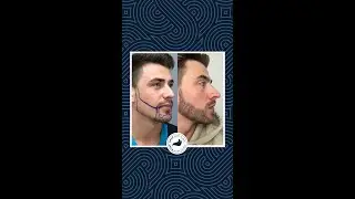 Beard Transplant - 9 Months Result of Liam!