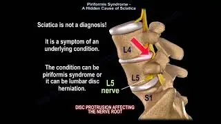 Piriformis Syndrome and Sciatica.