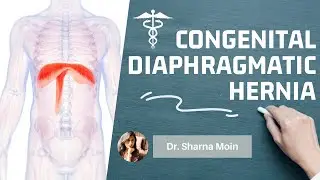 Congenital diaphragmatic hernia CDH   types, causes, mechanism, diagnosis & treatment