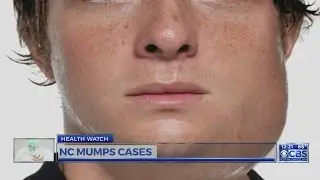 Dr. Campbell: 7 mumps cases reported in North Carolina last week