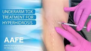 Underarm Tox Treatment for HyperHidrosis