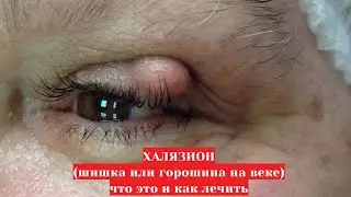 Халязион (шишка, горошина на веке) что это такое и какое существует  лечение: капли, уколы, операция