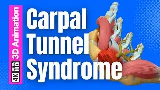 Carpal Tunnel Syndrome Surgery - 4K 3D Animation