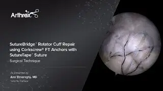 SutureBridge™ Rotator Cuff Repair using Corkscrew® FT Anchors with SutureTape™ Suture