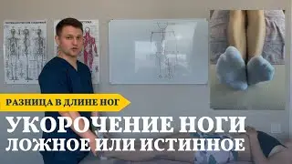 Укорочение ноги | Разница в длине ног | Нужны ли стельки?