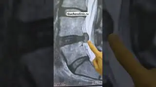 Грыжа диска рассосалась без следа.