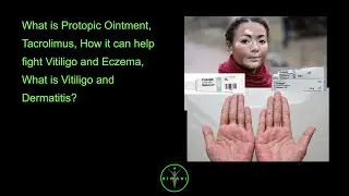 What is Protopic Ointment, Tacrolimus, How it can help fight Vitiligo and Eczema, What is Vitilig...