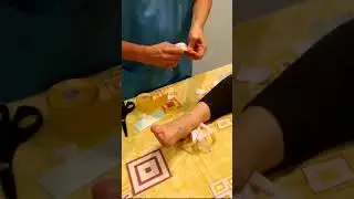 Тейпирование при травме стопы. Харламов Е.С.