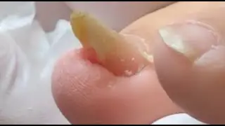 Plucking the sharp nails off the sides of the toes