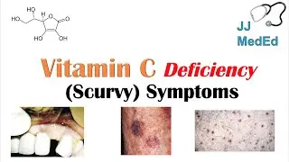 Vitamin C Deficiency (Scurvy) Symptoms (ex. bad teeth, fatigue), Why symptoms happen & who gets them