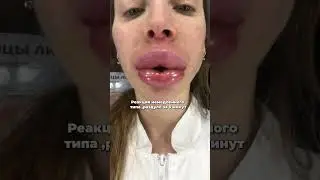 Удаление филлера и отек квинке после , осложнения после выведения филлера #губымосква #губы