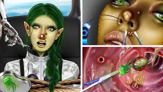 ASMR Treatment of swollen nose for aliens and miraculous transformation after surgery