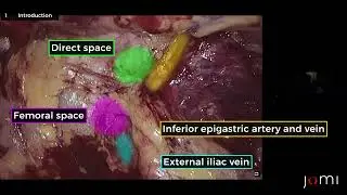 Surgery Steps:Laparoscopic Totally Extraperitoneal (TEP) Left Indirect Inguinal Hernia Repair w/Mesh