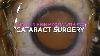 MIIQ 28: Routine Cataract Surgery || Phaco || DR. MD IFTEKHER IQBAL RAJU