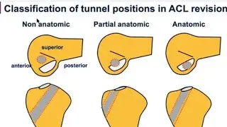 ACL Revision Principles: Wolf Petersen, MD