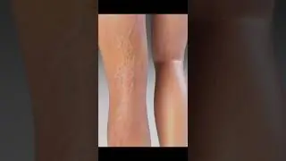 Varicose veins