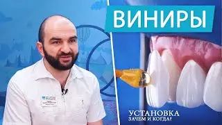 Виниры - плюсы и минусы. Зачем и когда устанавливать | часть 1