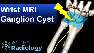 Why dorsal ganglion cysts are painful - MRI tips and tricks for ganglion cysts