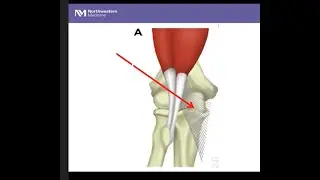 Distal Biceps Tendon Injuries