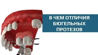 Съемные зубные протезы. Сравнение бюгельных протезов на кламмерах и аттачментах