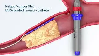 Philips Pioneer Plus IVUS-guided re-entry catheter