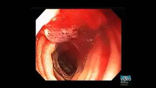 Small Bowel Lymphangioma